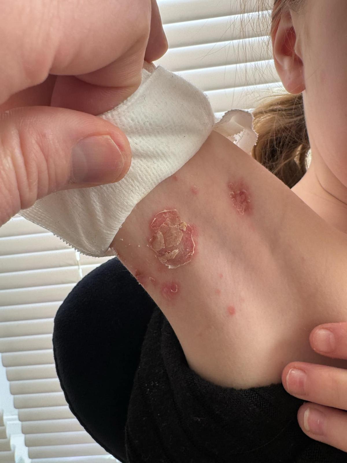 Atopinis dermatitas – kaip atpažinti ir gydyti?