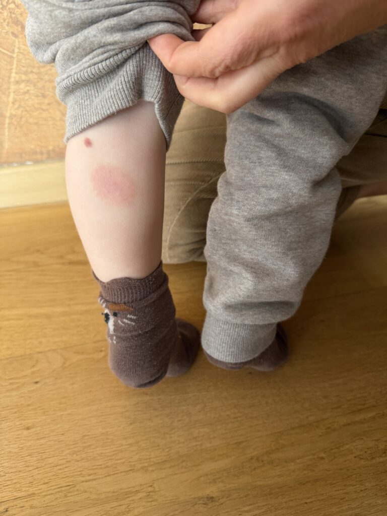 atopine oda, vaiku alergijos, vaiku alergologas, atopinis