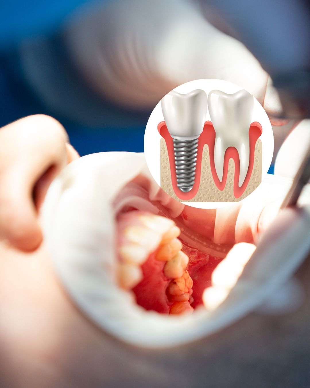 Alergijos tyrimas prieš dantų implantavimą