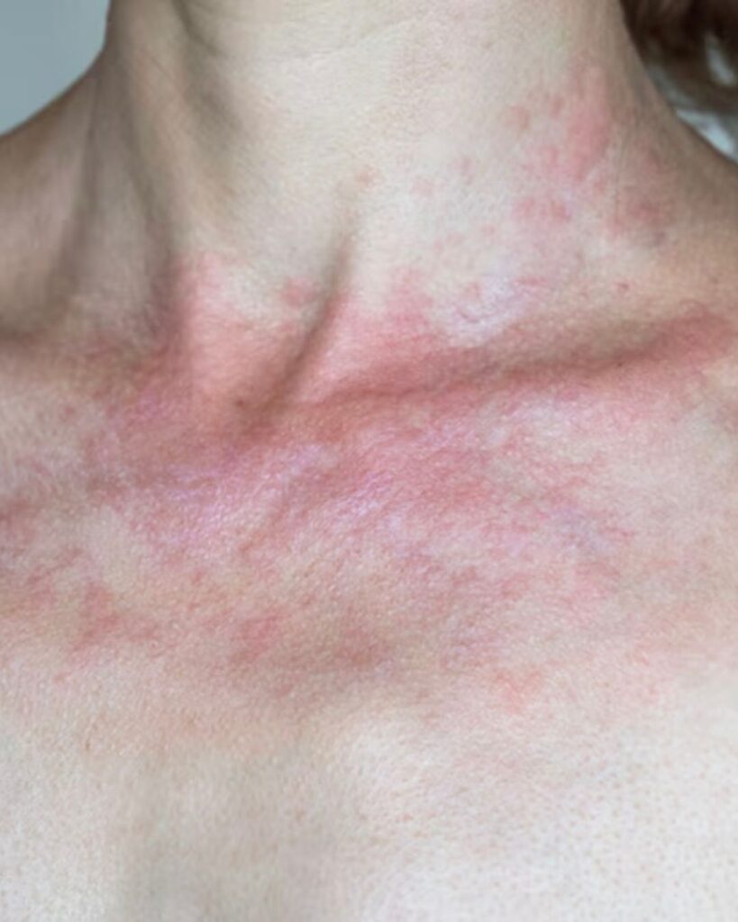 histamino netoleravimas, histaminas, odos berimai, alergija