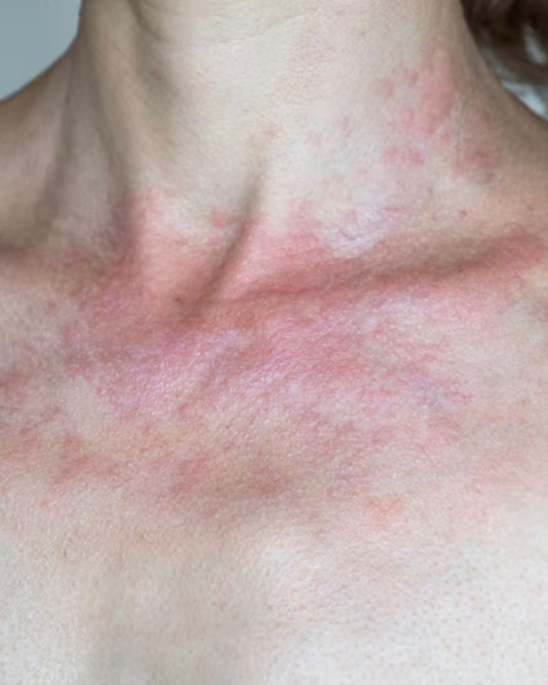 Kas yra histaminas ir histamino netoleravimas? Ką reikia žinoti? 